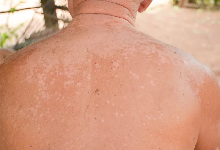 Most 10 Natural Remedies for Tinea Versicolor You At Home