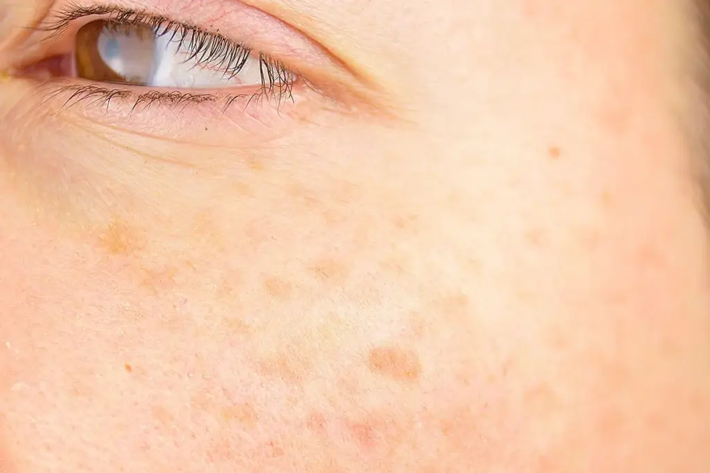 Best Actinic Keratosis Supplements to Repair Sun-Damaged Skin Naturally