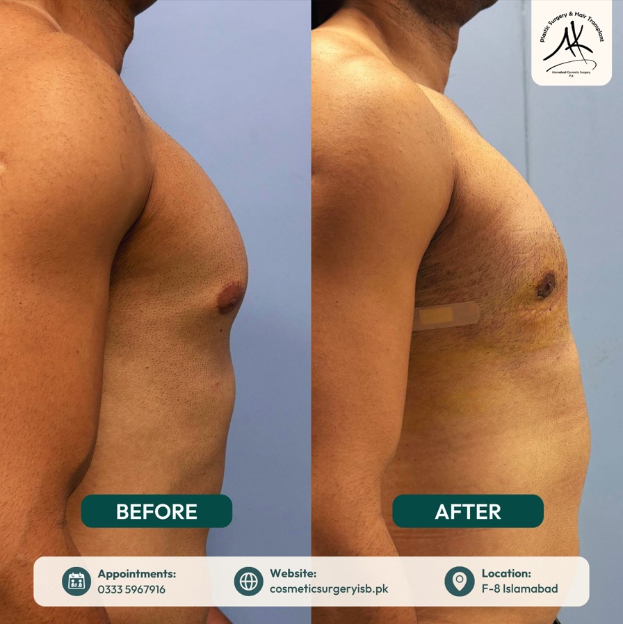 gynecomastia surgery islamabad