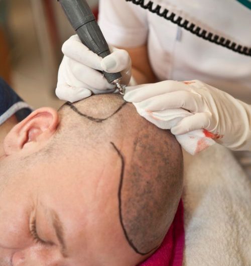 hair transplant in Lahore