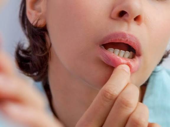 Burning Mouth Syndrome Supplements