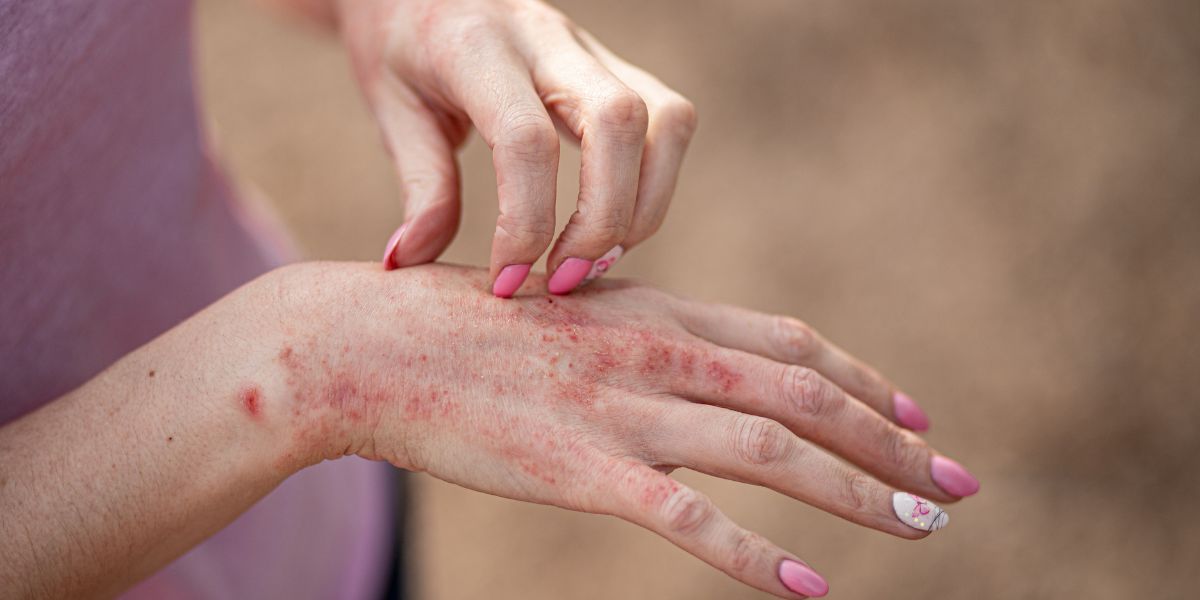 pediatric dermatologist in chennai