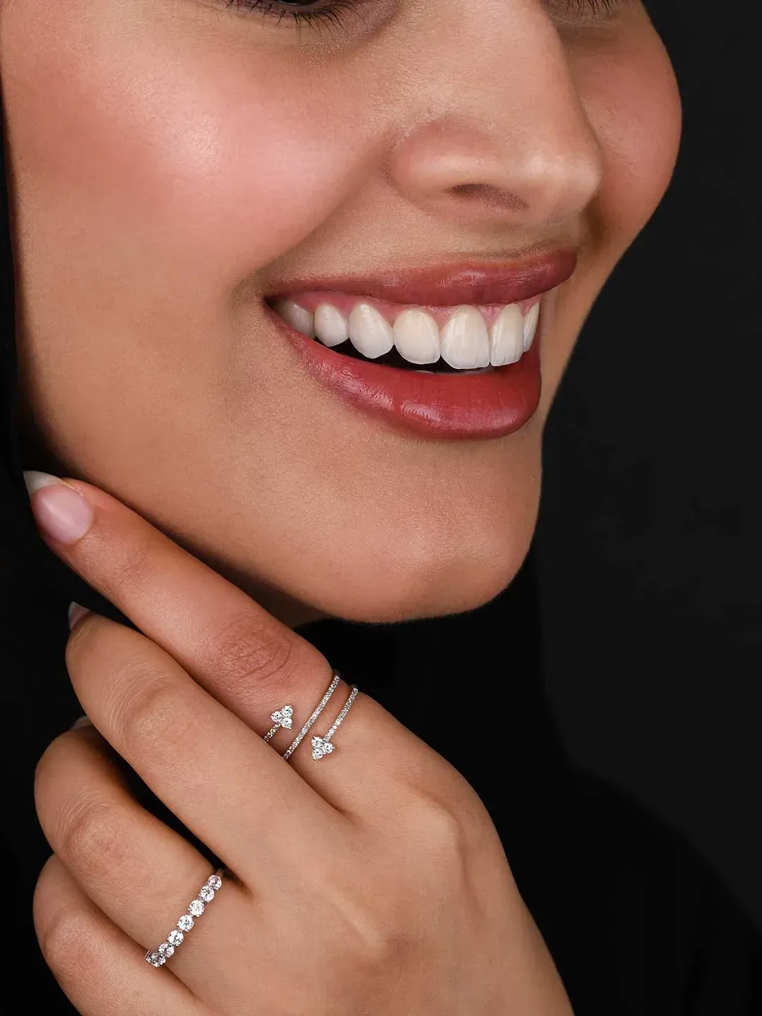 veneers in dubai