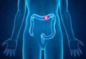colon cancer screening in dubai