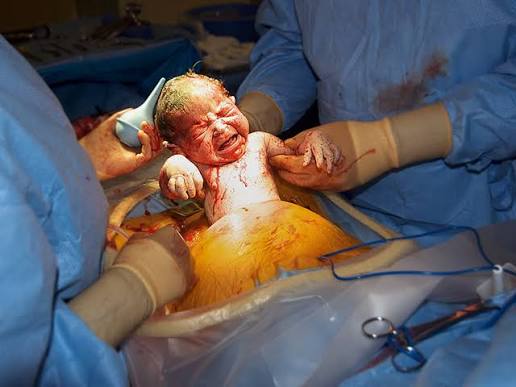 cesarean section surgery